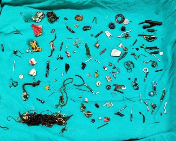 У мужчины два года непрерывно болел живот — рентгеновский снимок впечатлил медиков У мужчины два года непрерывно болел живот — рентгеновский снимок впечатлил медиков